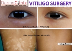 Vitiligo treatment in delhi