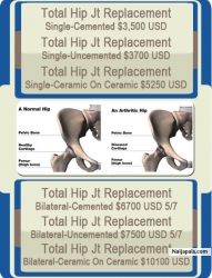 Hip Replacement Surgery in Pune, India