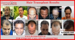 Hair Transplant