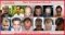 Hair Transplant