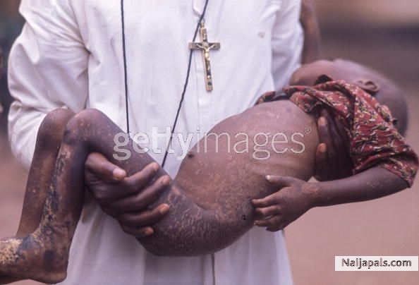 A child bearing burn-marks in the arms of a priest during the conflict in Biafra, a secessionist state in southern Nigeria, circa 1970. - click for next photo