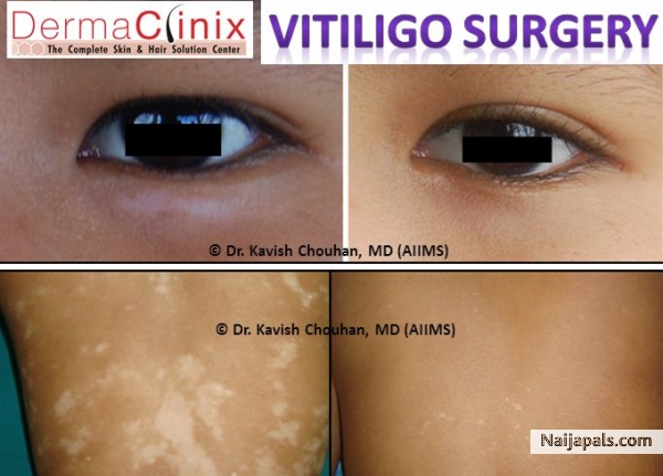 Vitiligo treatment in delhi - click for next photo