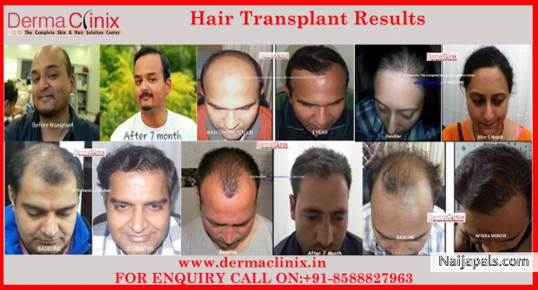 Hair Transplant - click for next photo